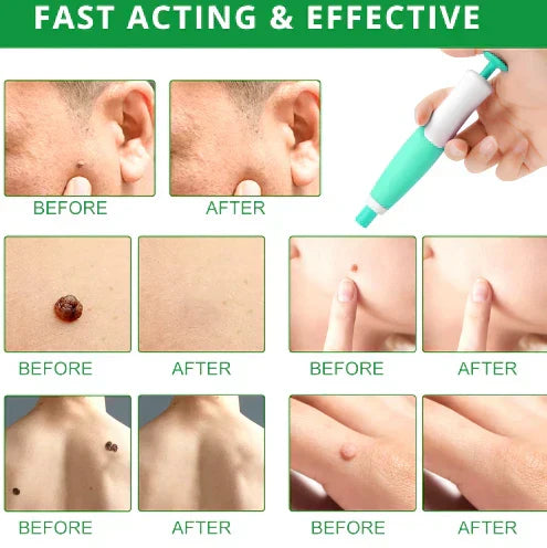 Zavinox 2-in-1 Painless Skin Tag, Mole, and Wart Removal Kit
